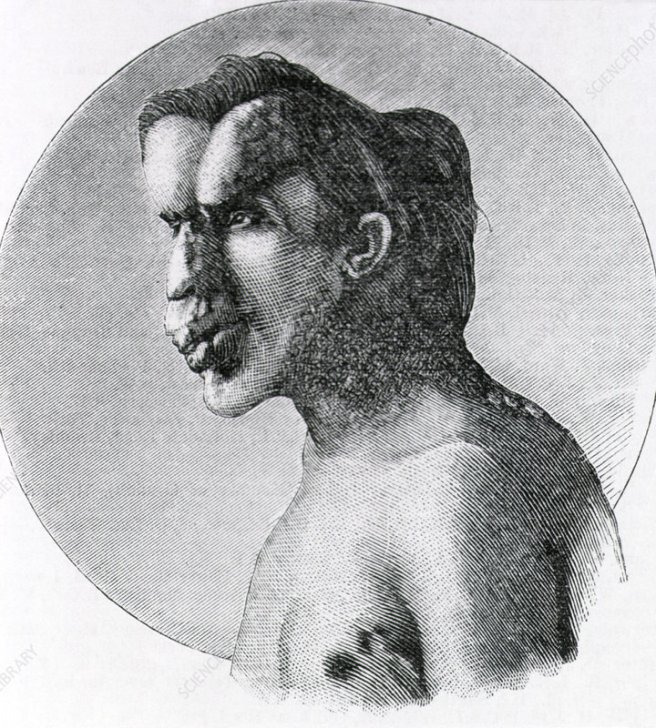 Joseph Merrick, The Elephant Man
